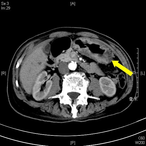 96岁超高龄胃部肿瘤成功切除不明原因乏力消瘦警惕这种癌症