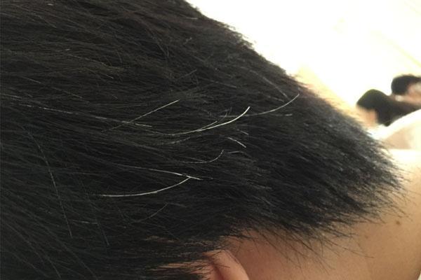 哪些原因会让人白发横生?可能是遗传导致