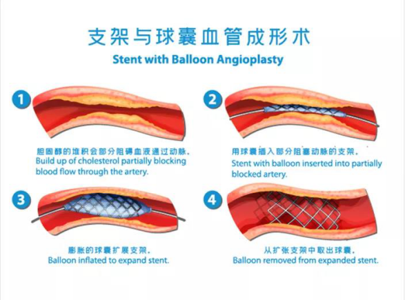 据了解,冠脉球囊全称冠状动脉球囊扩张导管.