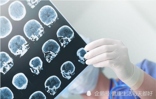 脑梗|58岁大叔突发脑梗，落下偏瘫，医生提醒：饭后2事，能不做就不做