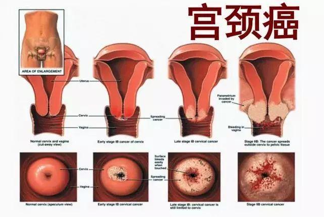 宫颈癌变不会悄无声息下半身早有2个红灯亮起别忽视掉