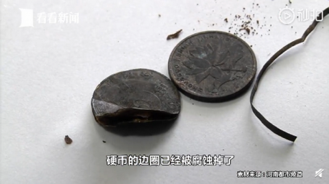 胃镜|男孩一年来肚子疼还老吐，胃镜一照竟有两枚硬币：过年吃饺子时误吞