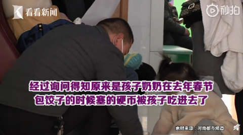 胃镜|男孩一年来肚子疼还老吐，胃镜一照竟有两枚硬币：过年吃饺子时误吞