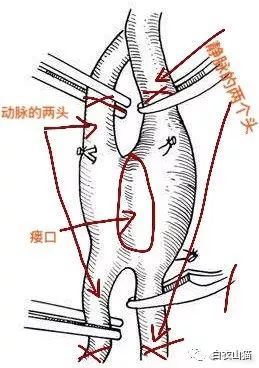 动脉脉瘘的四头结扎术就是如上图所示,把动静脉瘘的两条血管四个头