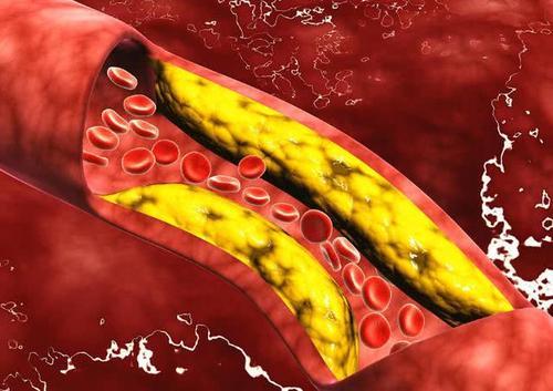 脑梗|53岁男子突发脑梗，家人失声痛哭！医生叹息：这东西怎么能当饭吃