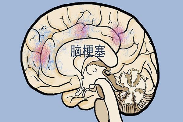 脑梗|53岁男子突发脑梗，家人失声痛哭！医生叹息：这东西怎么能当饭吃