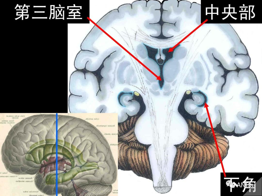 脑室系统 侧脑室 第三脑室 第四脑室(第五脑室 第六脑室 中脑水管