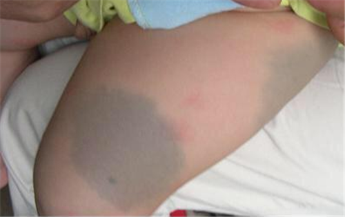 第二个特征就是青斑,这种青斑就像胎记一样,一般