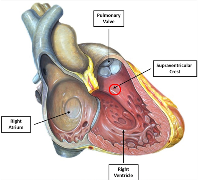 解剖上,室上嵴是右心室內的肌肉隆起(肌嵴),位於三尖瓣與肺動脈瓣之間