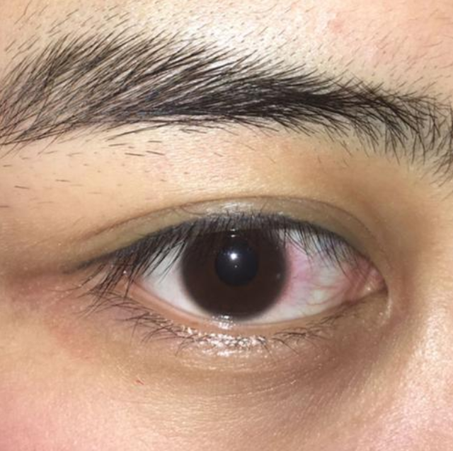 肝不好眼知道如若眼睛没出现这3种现象恭喜你的肝还很健康
