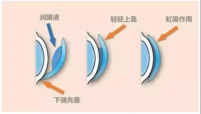 特點:滿足孩子和家長,白天不用外戴框架眼鏡,晚上佩戴角膜塑形鏡,夜間