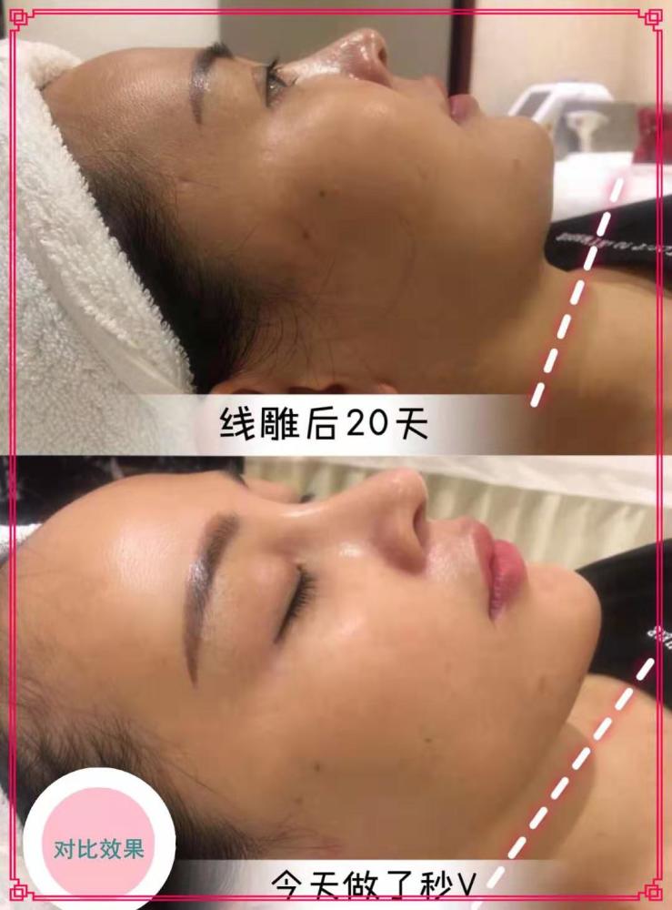 看婆婆线雕恢复期真实图片听耿直的小美说提线盾吃多久提升效果