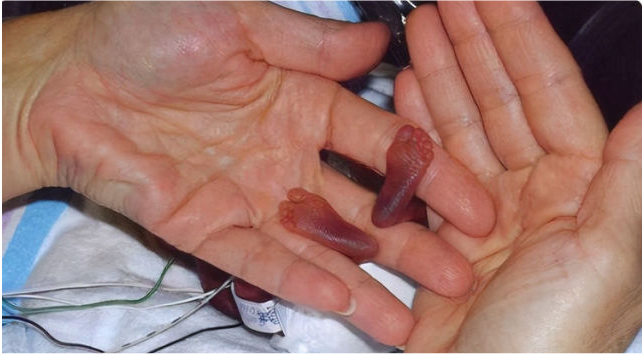 余文乐二胎女儿出生仅1公斤,妻子直言:安胎针打到手没地方可扎