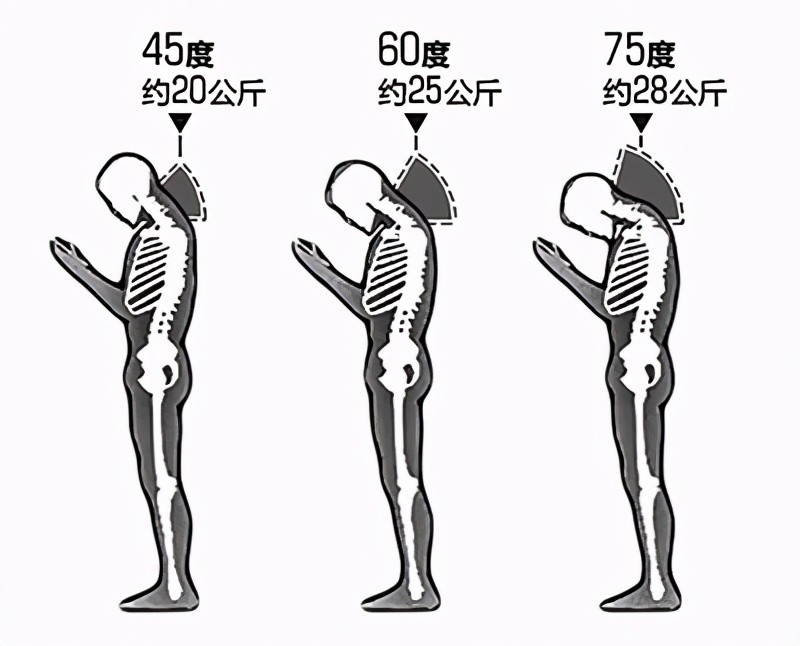 颈椎病|“低头族”成为颈椎病的“主力军”：一低头，颈椎负重50斤