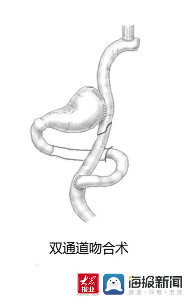 双通道吻合术图解手术后,在医生,护士及患者家属的全力合作下患者顺利