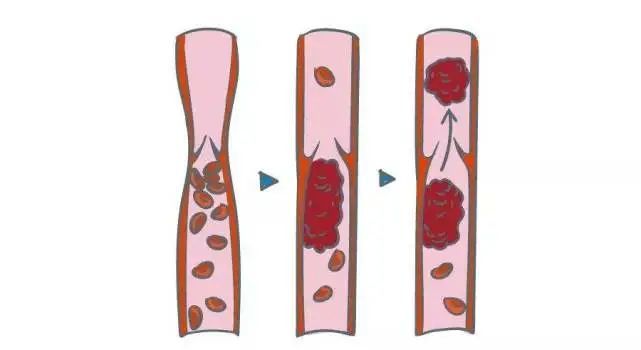 血栓|一有血栓，心脑不安，怎样才能赶走血栓，远离心梗、脑梗？