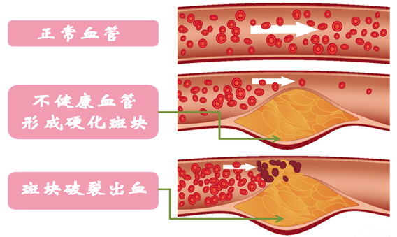 高脂血症|关于“无声杀手”高血脂的那些事儿，你了解多少？