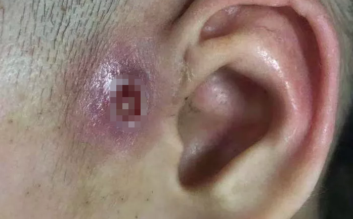 医生提醒:孩子耳朵上有这个小洞要小心