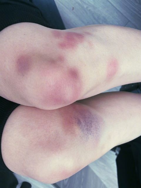 女性腿部青紫块图片图片