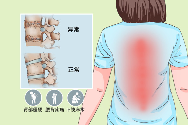 一位醫生自述如何得了強直得了強直後要注意這幾個事項