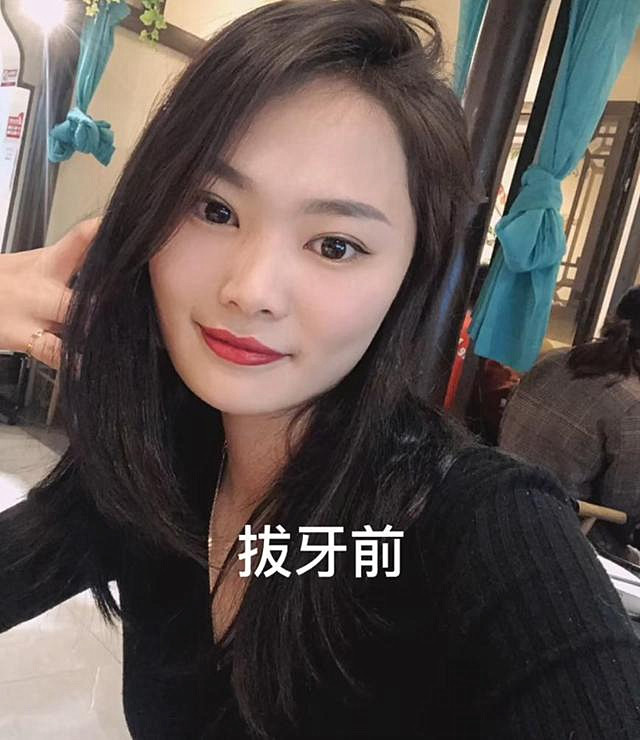 山东一女子连拔3颗智齿 脸肿成 土拨鼠 手术中途曾被吓哭 腾讯新闻