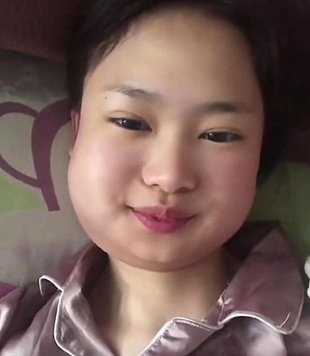 山东一女子连拔3颗智齿脸肿成土拨鼠手术中途曾被吓哭