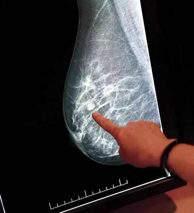 乳腺结节(乳腺增生结节)怎么回事,会消失吗_腾讯新闻