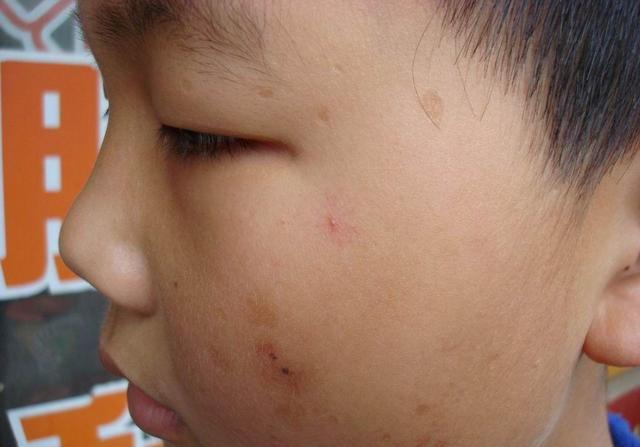 肝脏变硬,头部先知?若有4个迹象,最好尽快做个ct检查