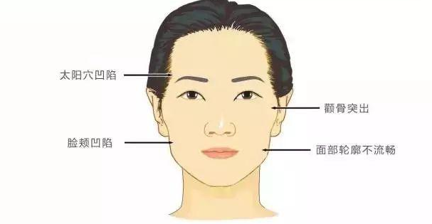 重慶當代安可忍院長帶你認清顴骨突出的臉型