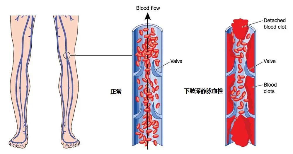 熬夜|男子熬夜打麻将后血栓跑进肺里？久坐突发胸闷需警惕！预防方法“一步到位”