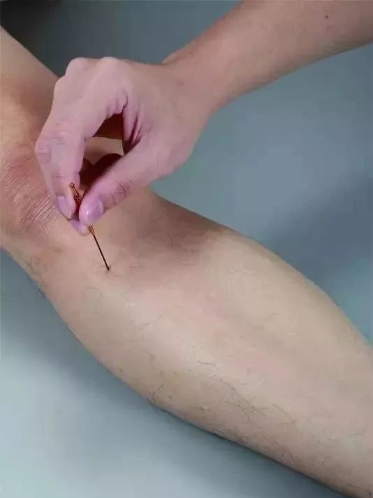 针方八个常用的针灸奇穴你知道几个