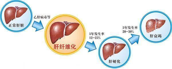 比抽菸還可怕大多數人深陷其中不知道毀肝更傷肝