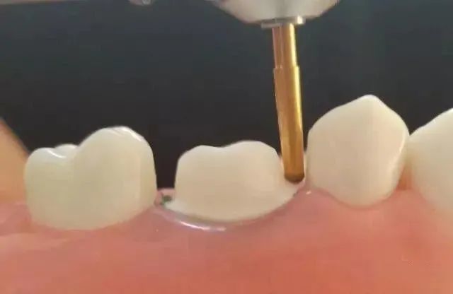 肩台精修车针9,颌面,各轴面冠方边缘的精细研磨:选择合适的细粒度车针