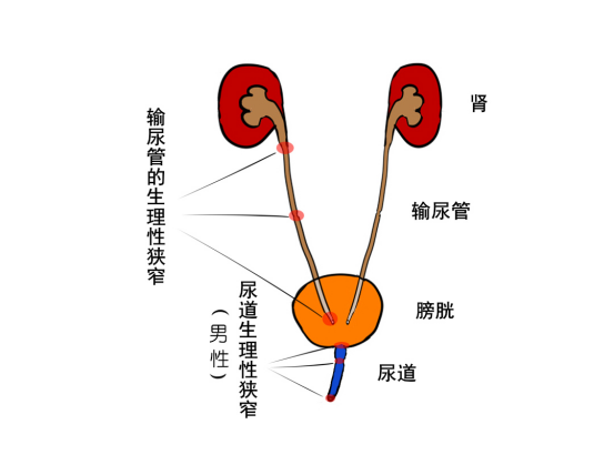 结石能不能排出来,关键看这4点|结石|输尿管