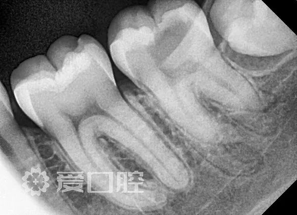 图1.根尖周内x光片显示龋齿接近左下颌第二磨牙中的牙髓