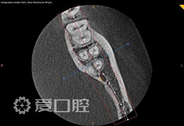 根管治療罕見的四根管下頜第二磨牙1例