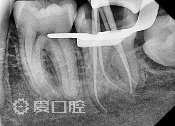 根管治療罕見的四根管下頜第二磨牙1例