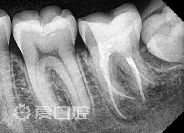 根管治療罕見的四根管下頜第二磨牙1例