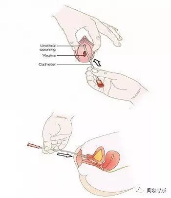 女性尿道口位于阴蒂的下方,阴道口的上方,且粗而短.