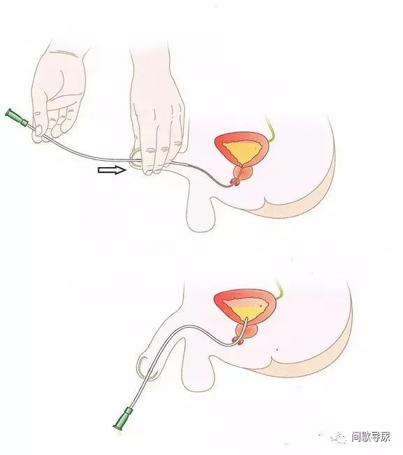 男性成人尿道长17～20cm,有两个弯曲:耻骨前弯和耻骨下弯;有3个狭窄部