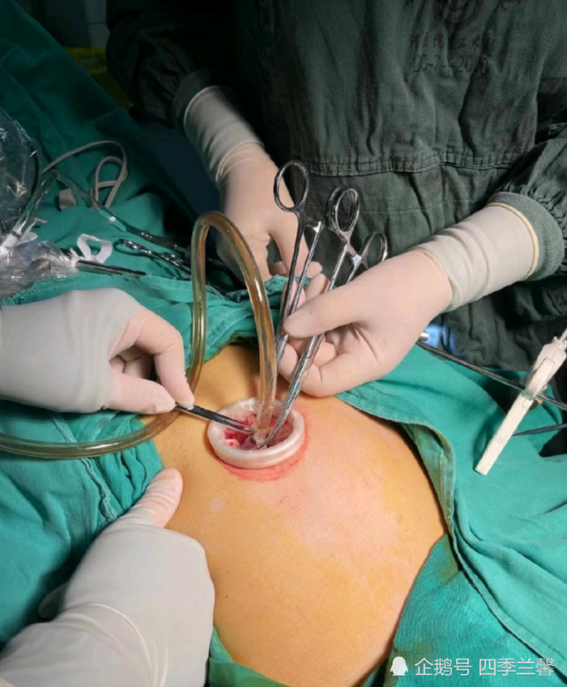 卵巢囊肿打孔手术图片图片