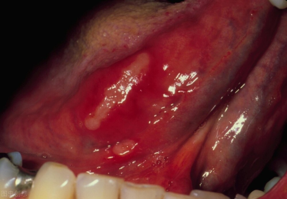口腔潰瘍就是口腔黏膜破裂,露出下面敏感的組織.
