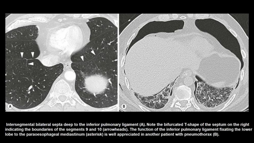 肺叶|一网打尽肺叶间附属裂