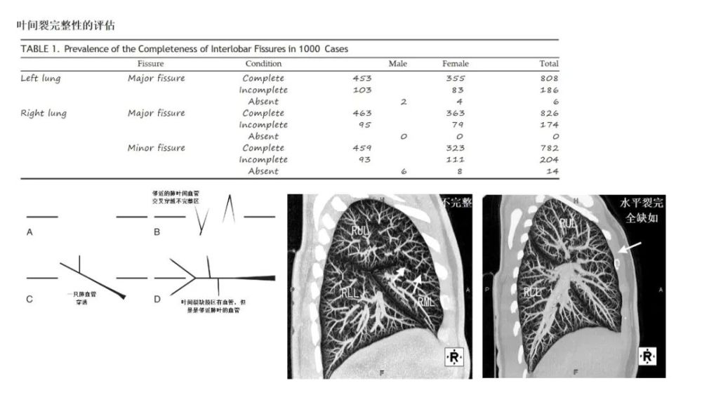 肺叶|一网打尽肺叶间附属裂