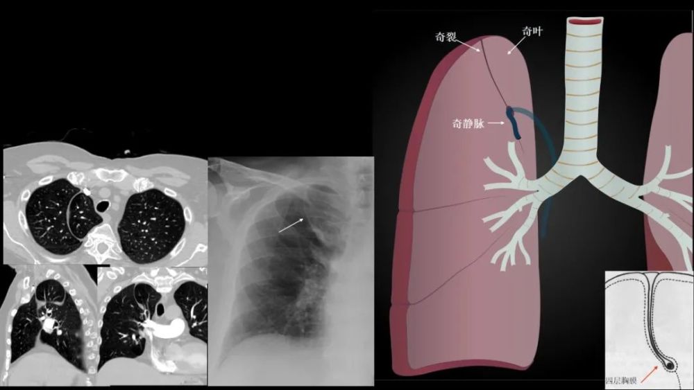 肺叶|一网打尽肺叶间附属裂