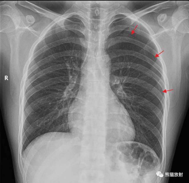 气胸|气胸时如何大体判断肺被压迫的程度？