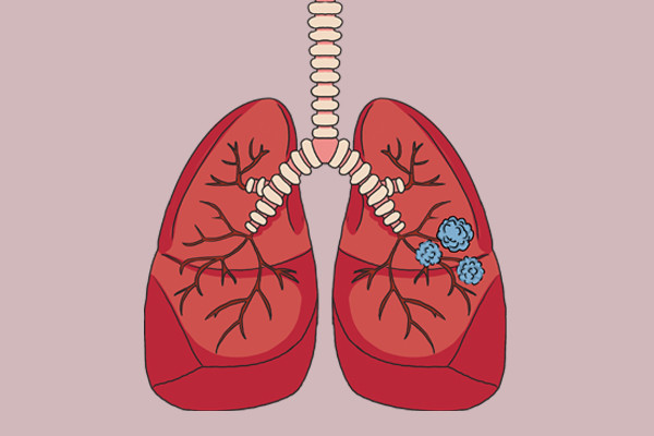 结节病|体内有结节的人，碰到3种食物，宁愿倒掉也别吃，易助长结节