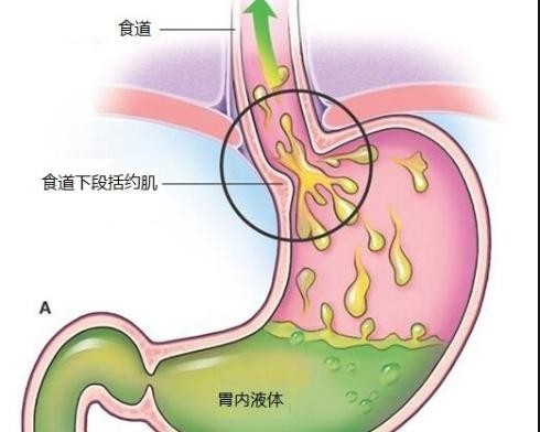 反流性食管炎|胃食管反流的痛苦你知道吗