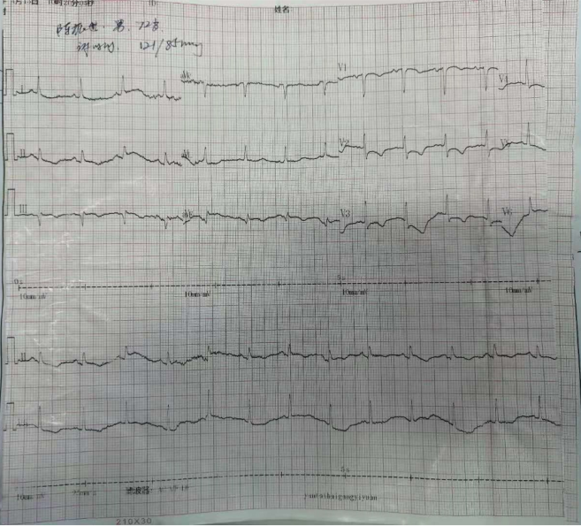 nstemi|【华医大查房】急性NSTEMI处理过程（一）