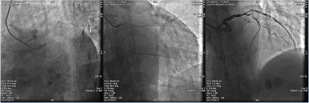 nstemi|【华医大查房】急性NSTEMI处理过程（一）